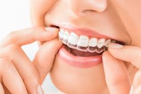 What Are the Advantages of Invisalign Used by Falls Church Dentists?