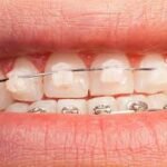 Best Reasons to Choose Clear Braces in Kelowna