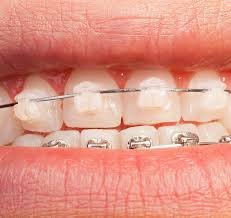 Best Reasons to Choose Clear Braces in Kelowna