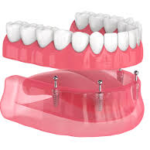 What Patients Can Expect When Dentists in Rolla Prepare for Implant-Supported Dentures